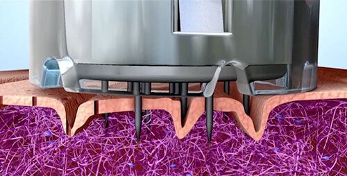 animation-still-microneedling